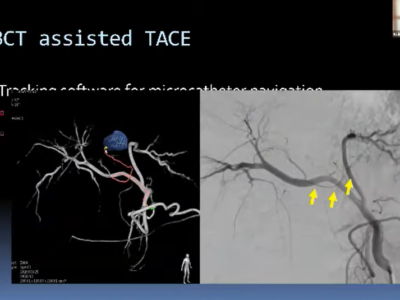 Pancreas & biliary surgery Interventional Radiology – partea 2 Pancreas & biliary surgery Interventional Radiology – partea 2